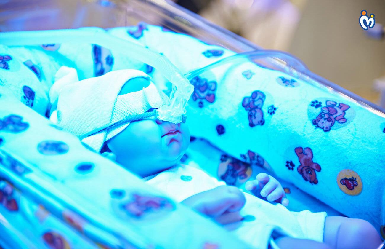 Jaundice in newborns - Things to know