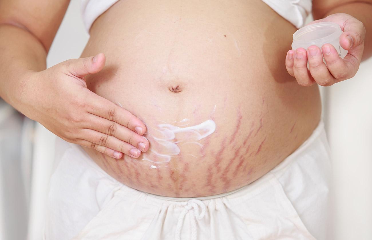 How to get rid of stretch marks at home