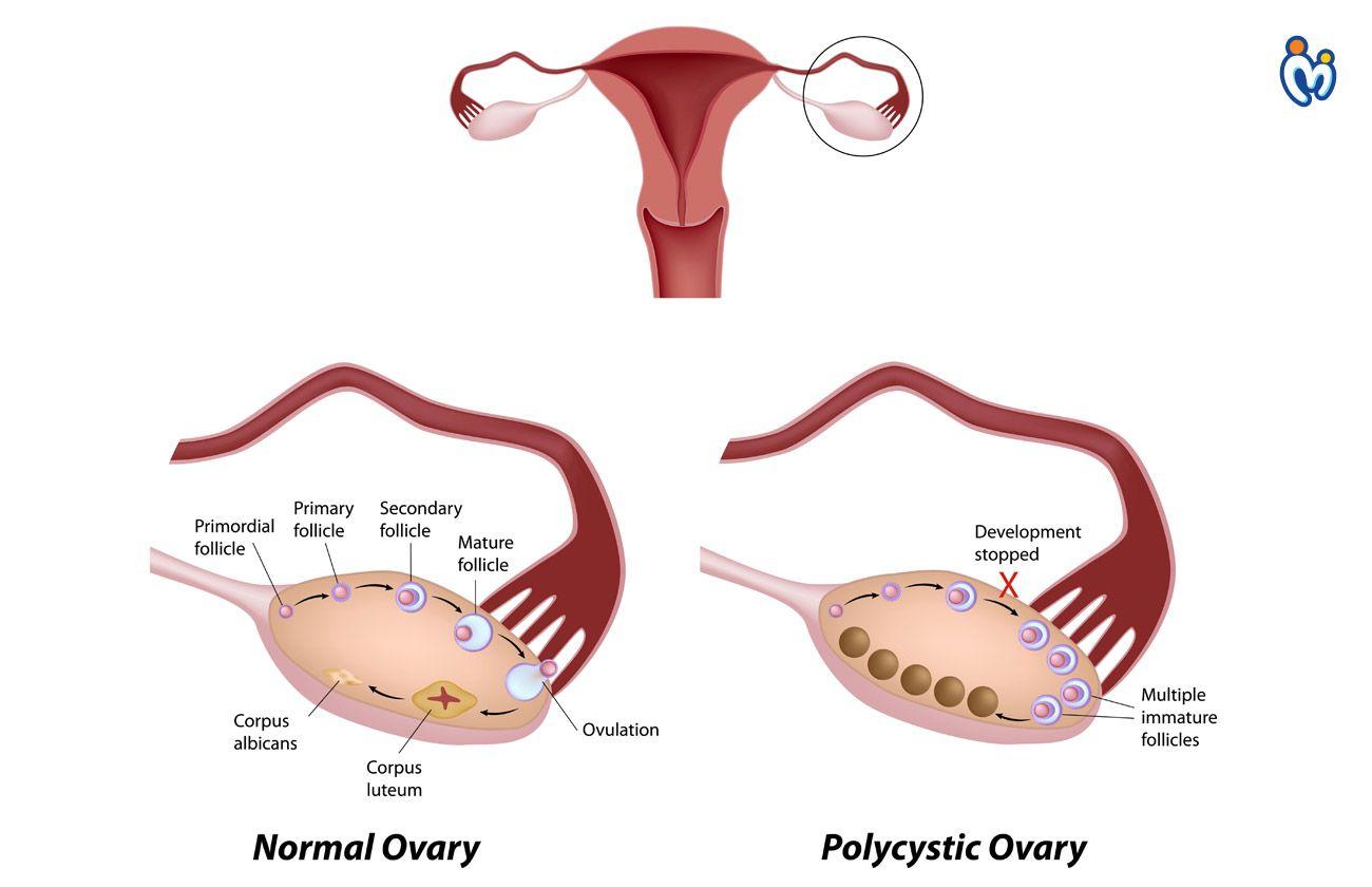 Pregnancy with PCOD Do’s & Don’ts