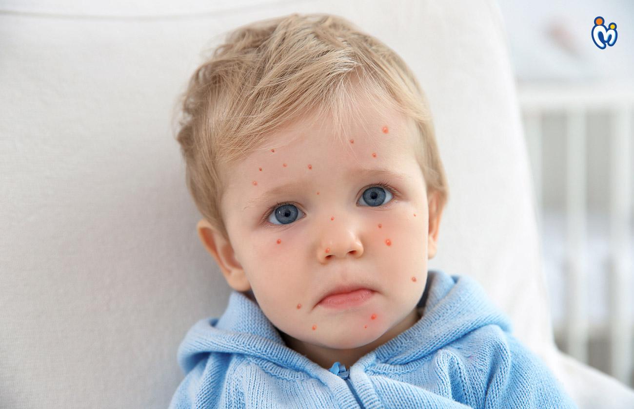 Chicken Pox Vaccine