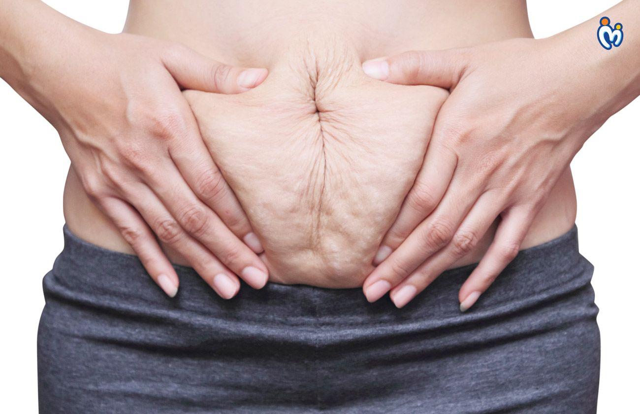Home remedies to get rid of stretch marks post-delivery naturally