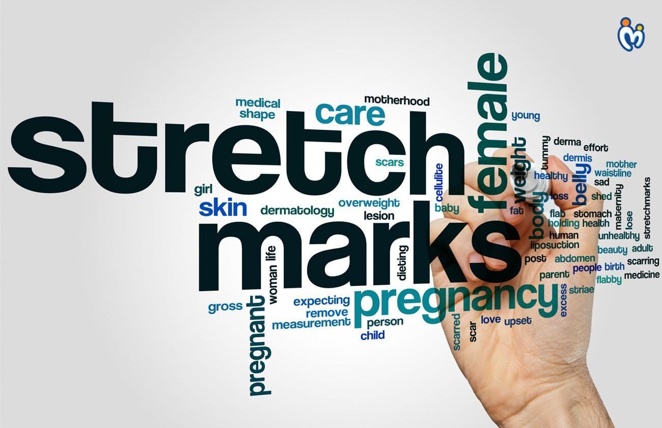 How To Avoid Stretch Marks In Pregnancy